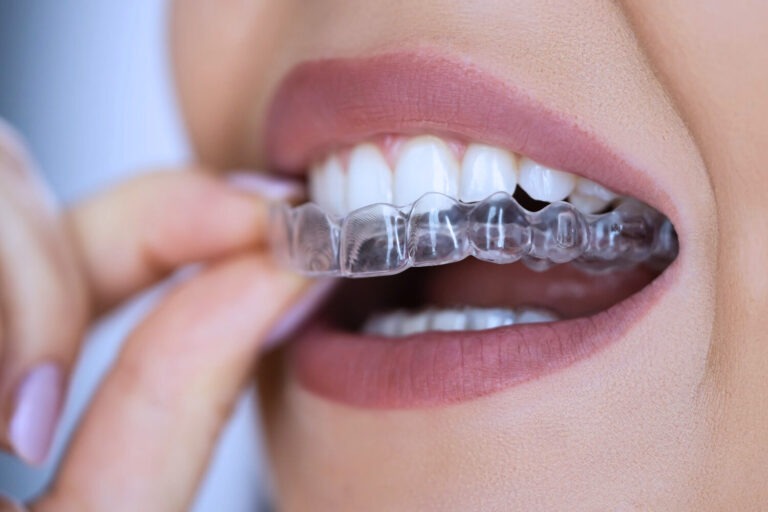 Spark Dental Aligners